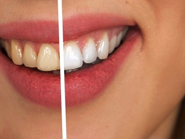 Schulung / Kurs: Schulung für die kosmetische Zahnaufhellung