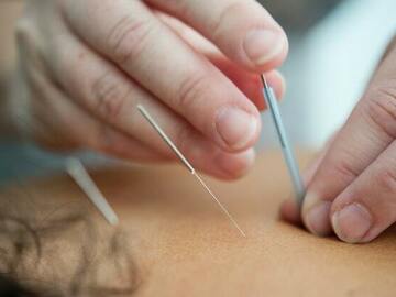 Appointments/Consultations - direct bookings: Acupuncture - Initial Consultation
