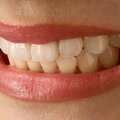 Information: Was Sie über Zahnveneers wissen sollten / Dental veneer