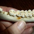 Information: Warum bekommen Zähne Karies?