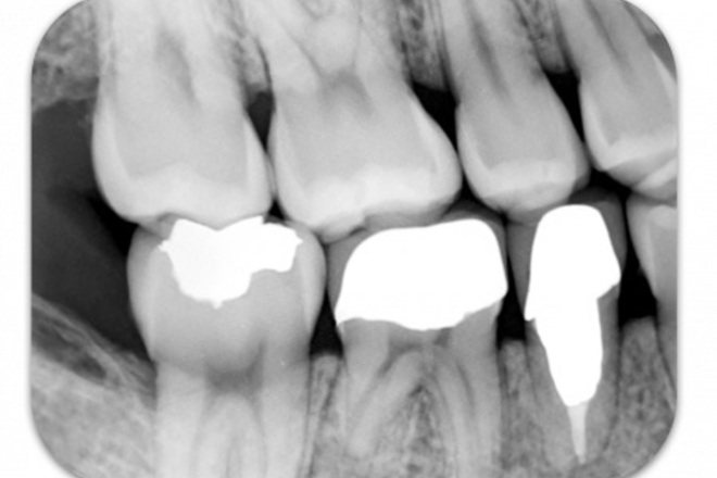 meX+DentX