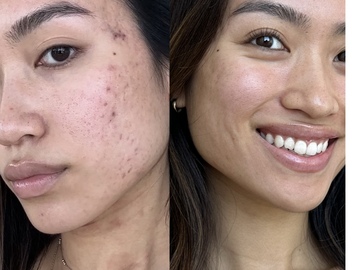 Wellness Session Single: Natural Solutions for Acne and Skin issues with Shiny
