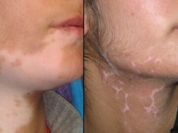 Skills:  Restore Natural Skin Color with Vitiligo Surgery