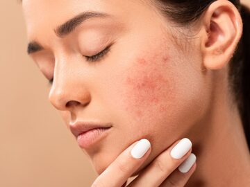 Skills: Expert Acne Scar Removal at Dermacian Jaipur