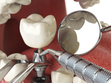 Kurs: Mój pierwszy implant – Intensywny kurs implantologii praktycznej 