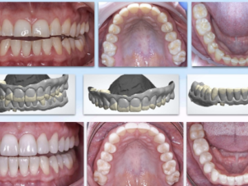 Course: Bonding and Tooth Wear – Część 4
