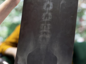 Darmowy kurs (ogłoszenie): Dostępy i stabilizacje przednie kręgosłupa lędźwiowego- ALIF, XLI