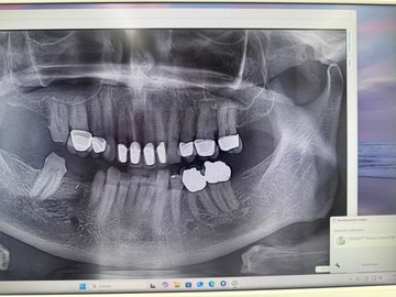 Gebruikte apparatuur: Soredex Cranex Novus OPG – Te koop (defect in hoogteverstelling)